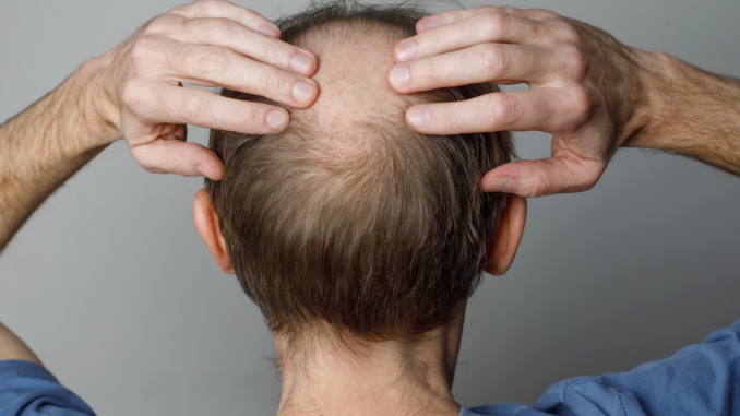Finasteride Finasteride