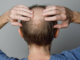 Finasteride
