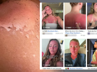 Sunburn