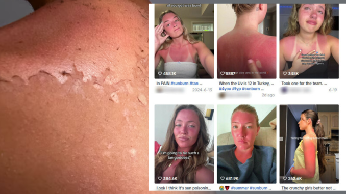 Sunburn
